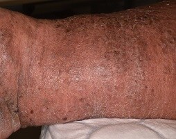 Fibroosi

