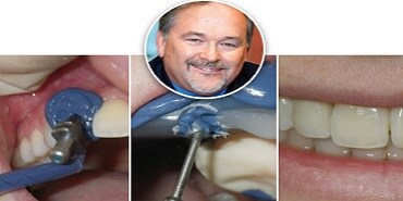 Tapaus: Ennustettavat implanttijäljennökset
